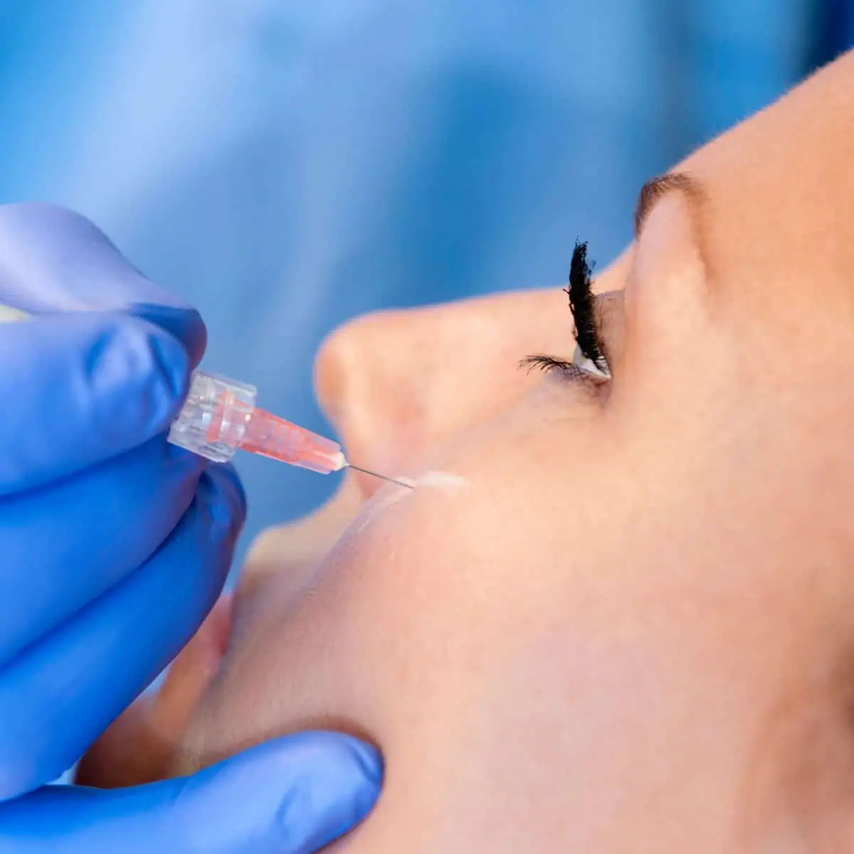 Design sans titre (41) (1) Plan rapproché d'une personne recevant une injection cosmétique près de la pommette, une main gantée bleue tenant une seringue à fine aiguille au ras de la peau sous l'œil.