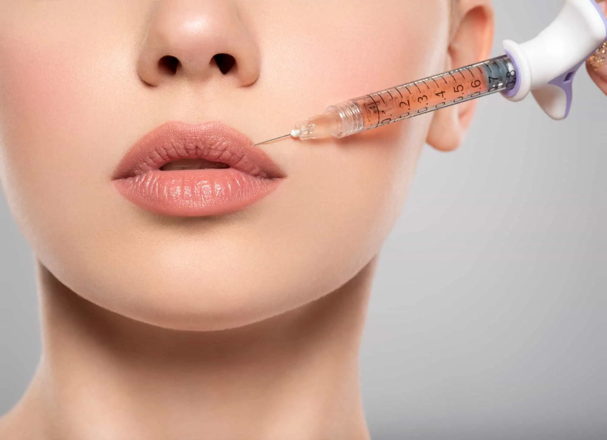 Injections d’acide hyaluronique Gros plan sur le bas du visage d'une femme aux lèvres rosées pendant une injection de comblement esthétique, une seringue graduée avec aiguille positionnée près de la lèvre supérieure.